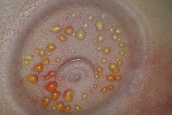 拔火罐為什么會(huì)起水泡,拔罐出水泡怎么辦