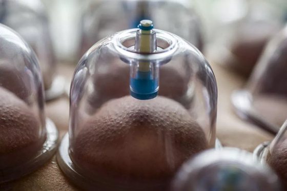 拔火罐為什么會(huì)起水泡,拔罐出水泡怎么辦