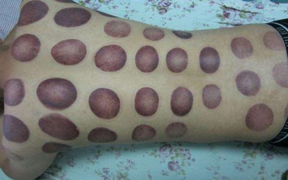 拔火罐為什么會(huì)起水泡,拔罐出水泡怎么辦