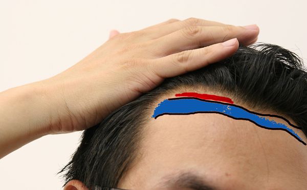 發(fā)際線為什么會(huì)后移,發(fā)際線后移該怎么辦