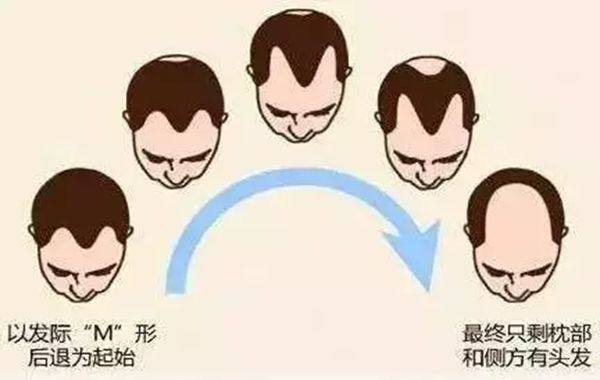 發(fā)際線為什么會(huì)后移,發(fā)際線后移該怎么辦