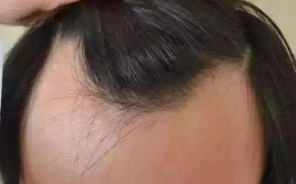 發(fā)際線為什么會(huì)后移,發(fā)際線后移該怎么辦